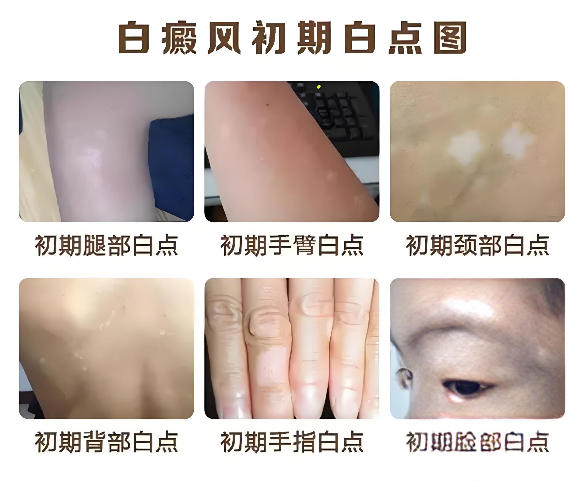 近期重点-泉州哪一家白癜风医院好？白癜风初期症状图片大全？